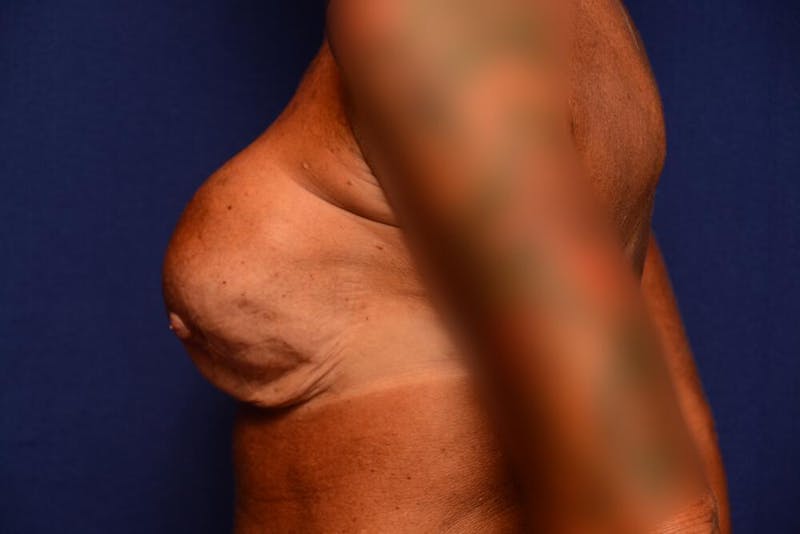 Breast Revision Before & After Gallery - Patient 312617 - Image 1
