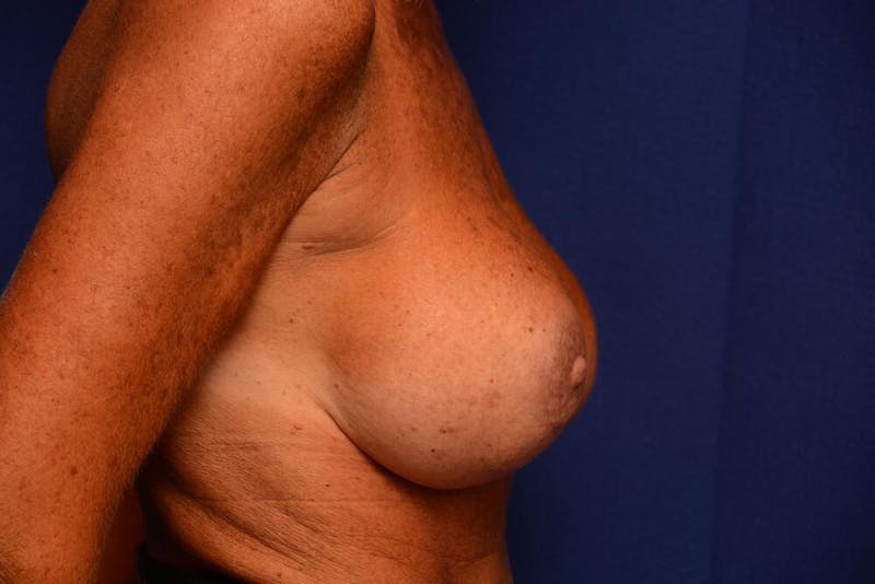 Breast Revision Before & After Gallery - Patient 312617 - Image 10