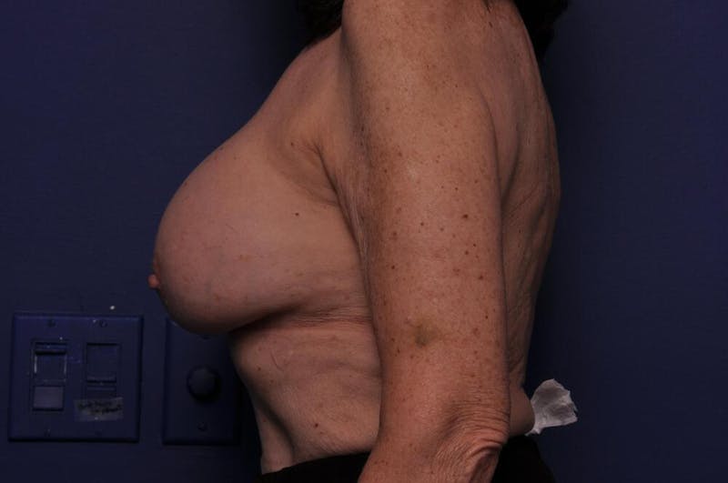Breast Revision Before & After Gallery - Patient 206032 - Image 2