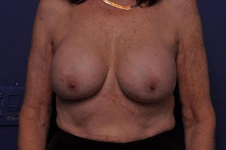 Breast Revision Before & After Gallery - Patient 206032 - Image 6