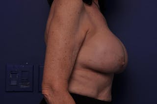 Breast Revision Before & After Gallery - Patient 206032 - Image 10