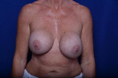 Breast Revision Before & After Gallery - Patient 394120 - Image 1