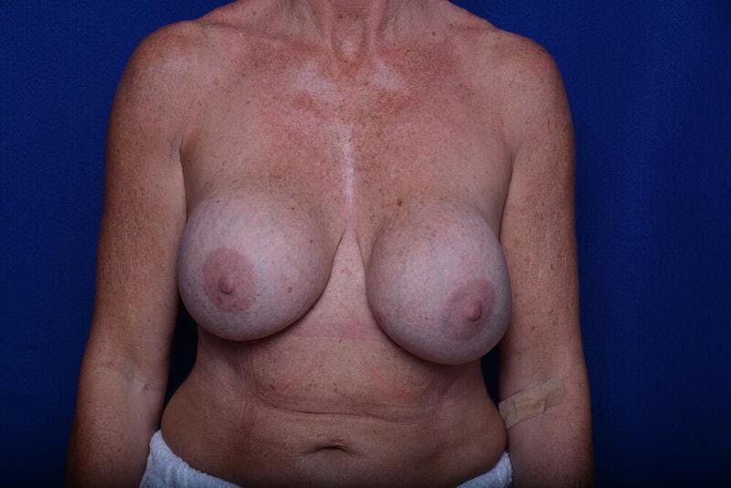 Breast Revision Before & After Gallery - Patient 394120 - Image 1