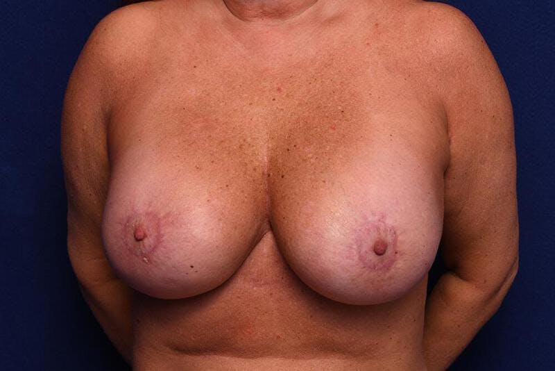 Breast Revision Before & After Gallery - Patient 132612 - Image 2