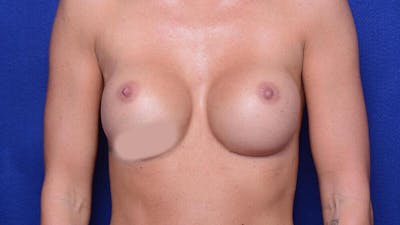 Breast Revision Before & After Gallery - Patient 398101 - Image 1