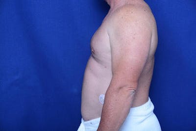 Gynecomastia Before & After Gallery - Patient 155339 - Image 2
