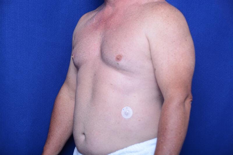 Gynecomastia Before & After Gallery - Patient 155339 - Image 3