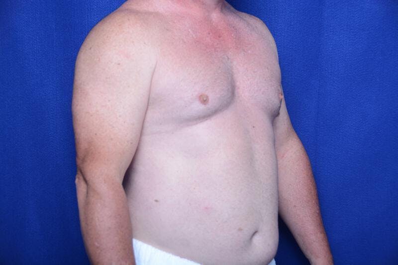 Gynecomastia Before & After Gallery - Patient 155339 - Image 7