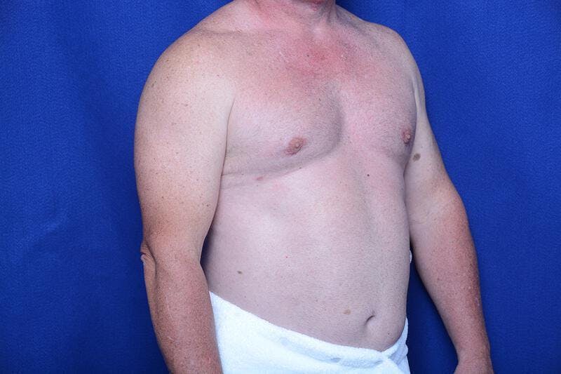 Gynecomastia Before & After Gallery - Patient 155339 - Image 8