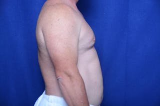Gynecomastia Before & After Gallery - Patient 155339 - Image 10