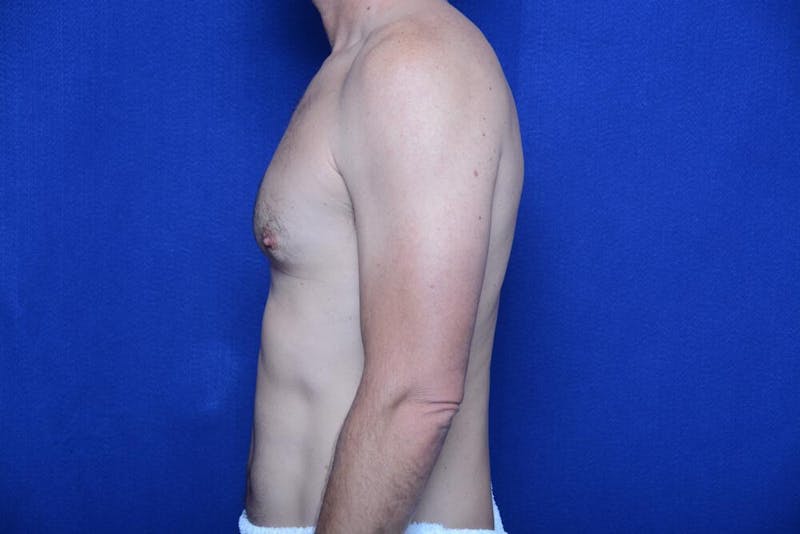 Gynecomastia Before & After Gallery - Patient 230626 - Image 1