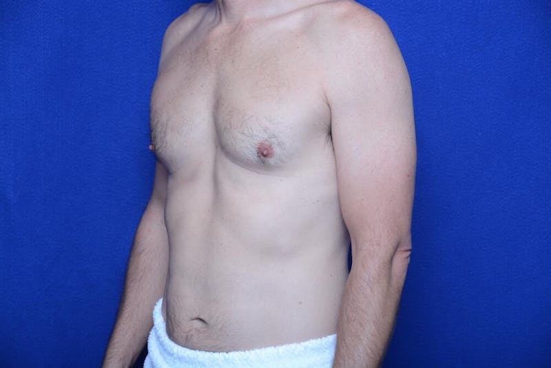 Gynecomastia Before & After Gallery - Patient 230626 - Image 3