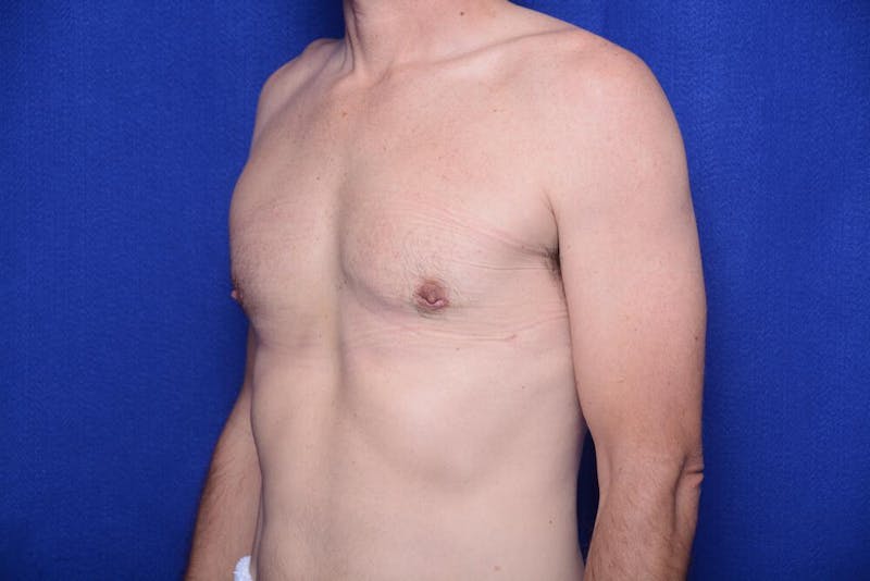 Gynecomastia Before & After Gallery - Patient 230626 - Image 4