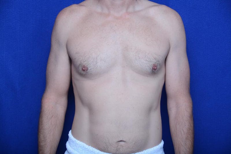 Gynecomastia Before & After Gallery - Patient 230626 - Image 5