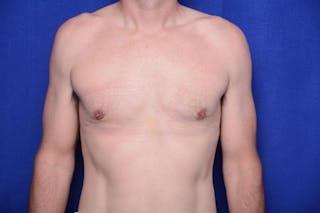 Gynecomastia Before & After Gallery - Patient 230626 - Image 6