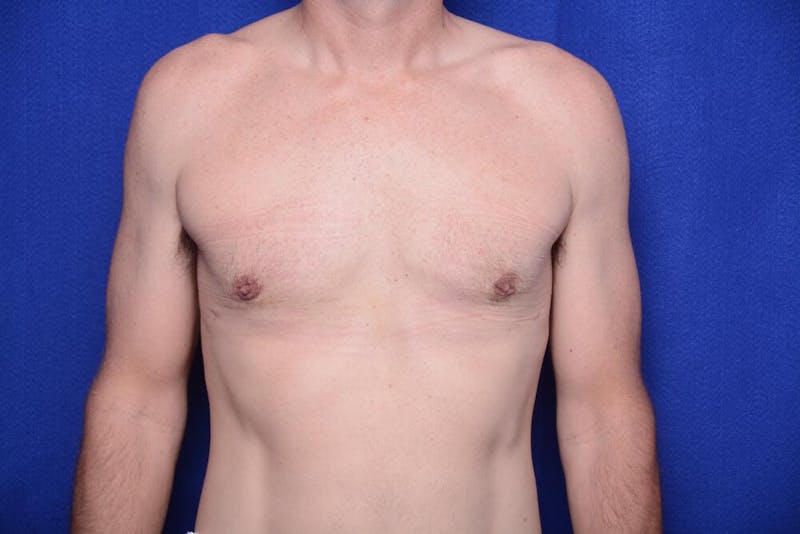 Gynecomastia Before & After Gallery - Patient 230626 - Image 6