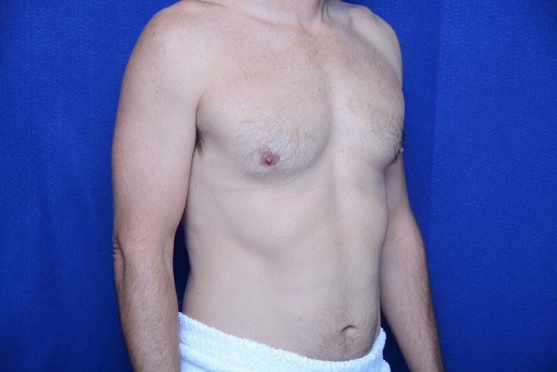 Gynecomastia Before & After Gallery - Patient 230626 - Image 7