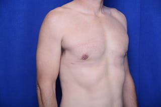 Gynecomastia Before & After Gallery - Patient 230626 - Image 8