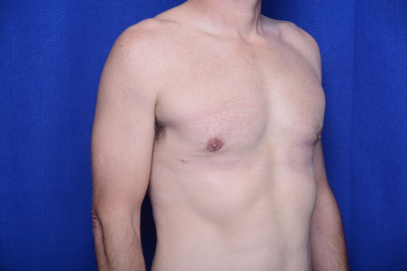 Gynecomastia Before & After Gallery - Patient 230626 - Image 8