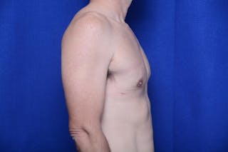 Gynecomastia Before & After Gallery - Patient 230626 - Image 10