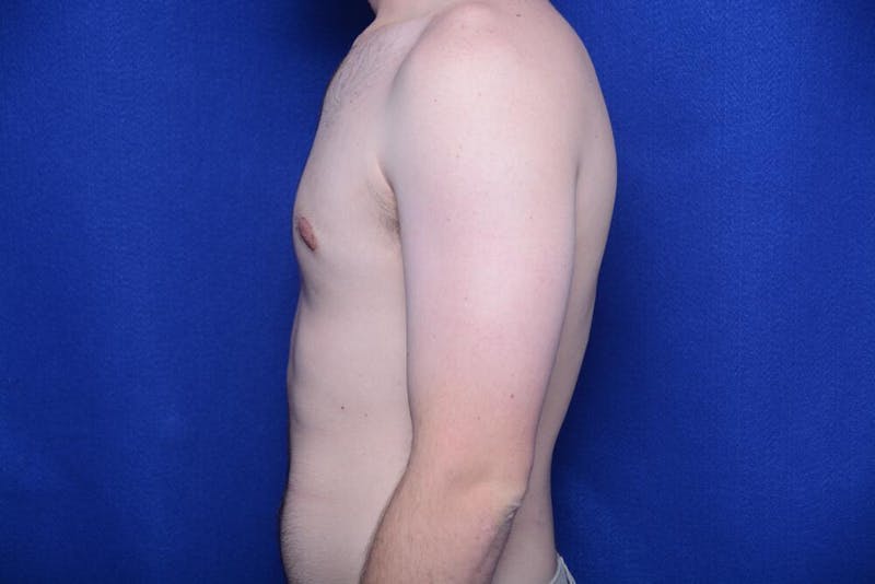 Gynecomastia Before & After Gallery - Patient 341127 - Image 2