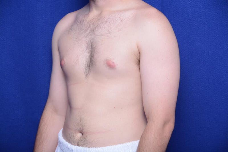 Gynecomastia Before & After Gallery - Patient 341127 - Image 3