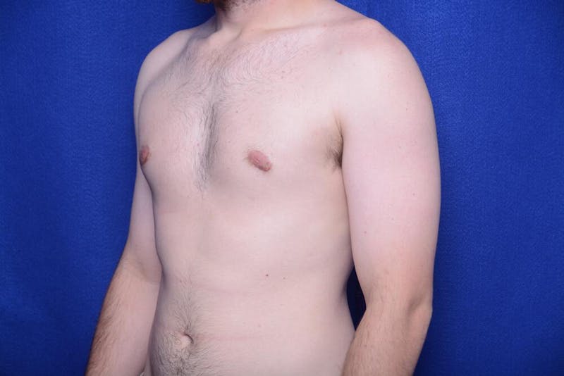 Gynecomastia Before & After Gallery - Patient 341127 - Image 4