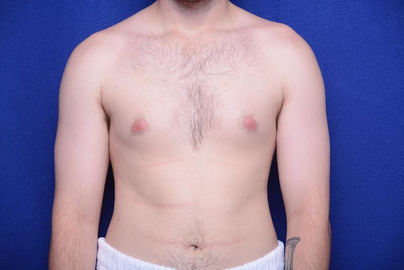 Gynecomastia Before & After Gallery - Patient 341127 - Image 5