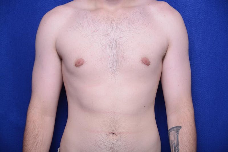 Gynecomastia Before & After Gallery - Patient 341127 - Image 6