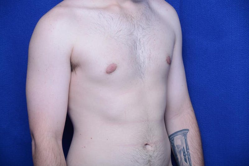 Gynecomastia Before & After Gallery - Patient 341127 - Image 8