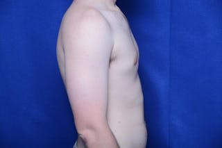 Gynecomastia Before & After Gallery - Patient 341127 - Image 10