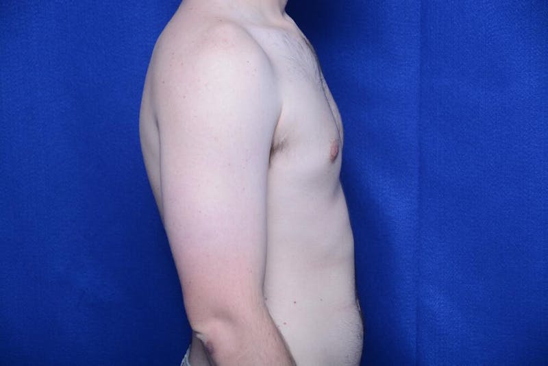 Gynecomastia Before & After Gallery - Patient 341127 - Image 10