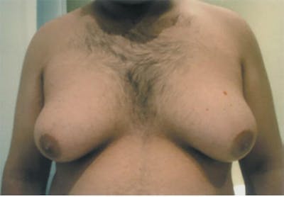 Gynecomastia Before & After Gallery - Patient 609081 - Image 1