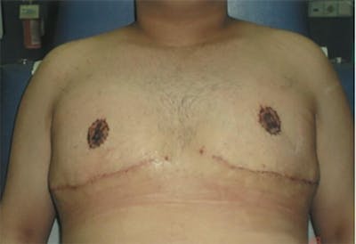 Gynecomastia Before & After Gallery - Patient 609081 - Image 2