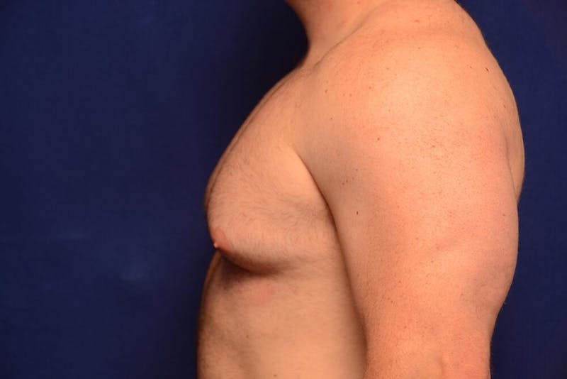 Gynecomastia Before & After Gallery - Patient 198134 - Image 1