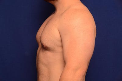 Gynecomastia Before & After Gallery - Patient 198134 - Image 2