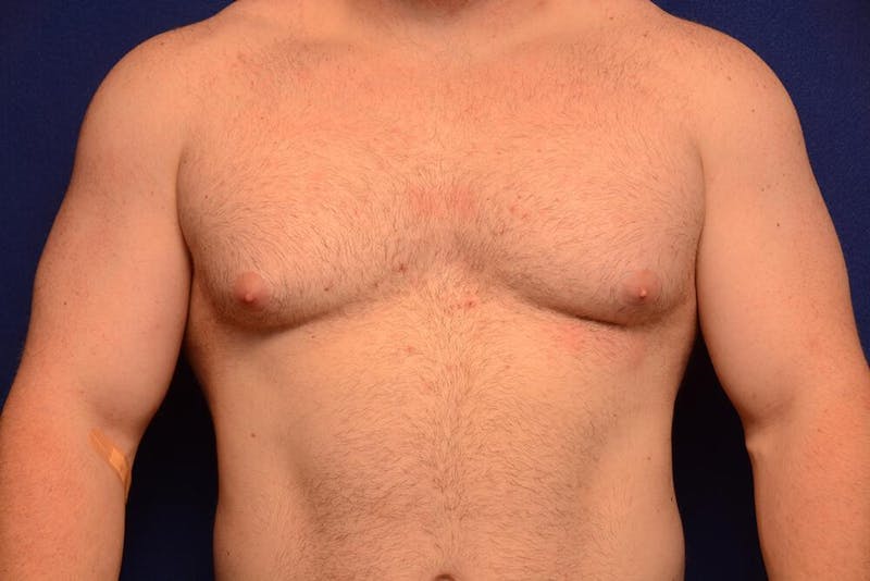 Gynecomastia Before & After Gallery - Patient 198134 - Image 5