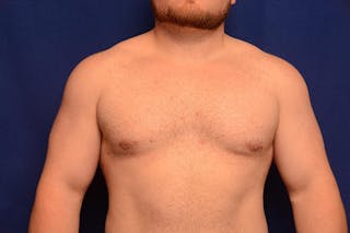 Gynecomastia Before & After Gallery - Patient 198134 - Image 6