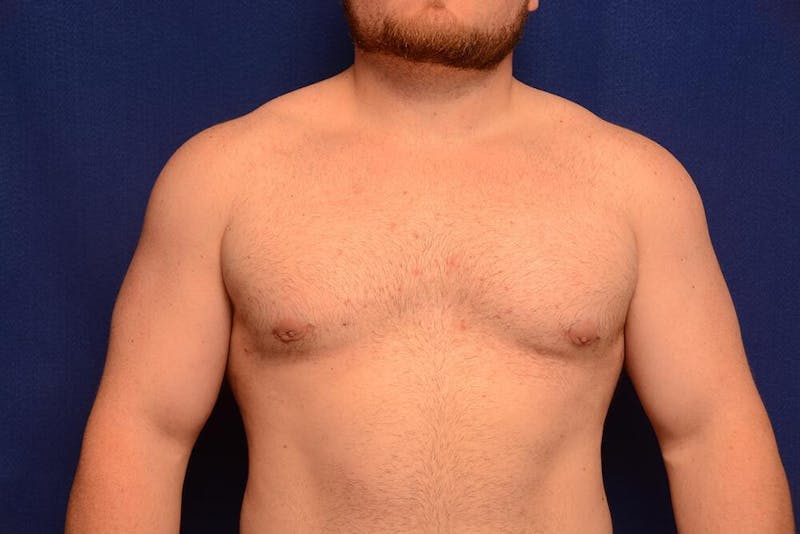 Gynecomastia Before & After Gallery - Patient 198134 - Image 6
