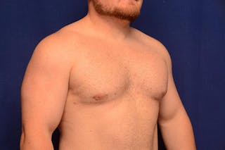 Gynecomastia Before & After Gallery - Patient 198134 - Image 8