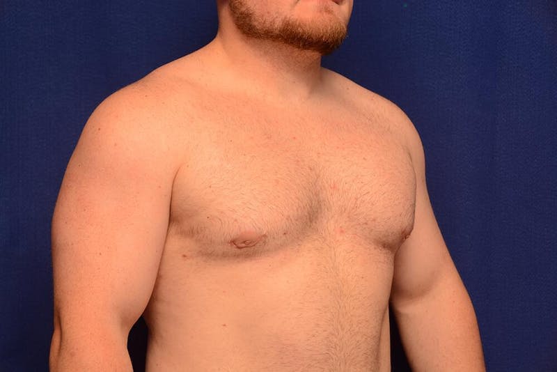 Gynecomastia Before & After Gallery - Patient 198134 - Image 8