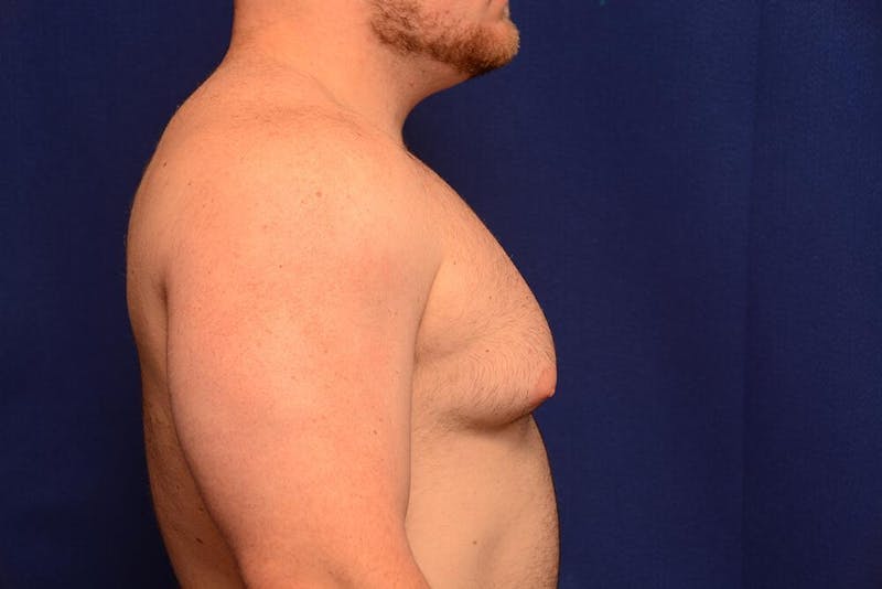 Gynecomastia Before & After Gallery - Patient 198134 - Image 9