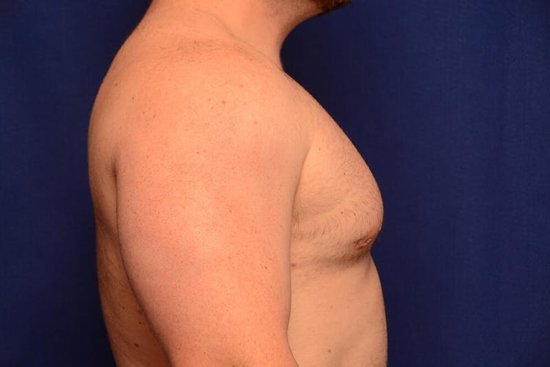 Gynecomastia Before & After Gallery - Patient 198134 - Image 10