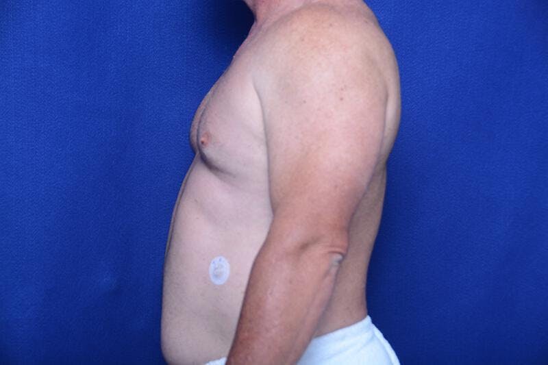 Gynecomastia Before & After Gallery - Patient 369541 - Image 1