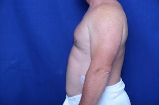Gynecomastia Before & After Gallery - Patient 369541 - Image 2