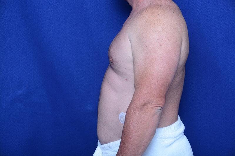 Gynecomastia Before & After Gallery - Patient 369541 - Image 2