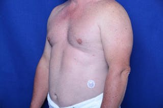 Gynecomastia Before & After Gallery - Patient 369541 - Image 4