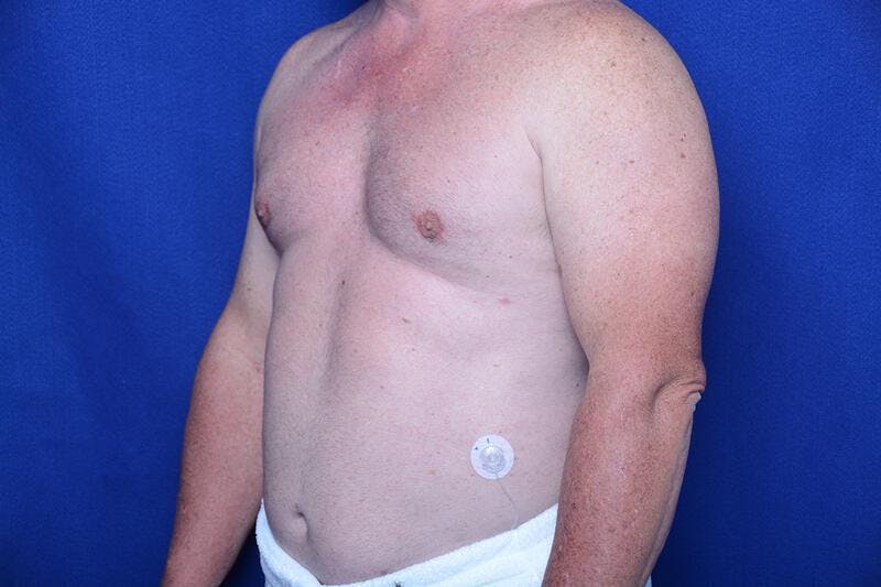Gynecomastia Before & After Gallery - Patient 369541 - Image 4