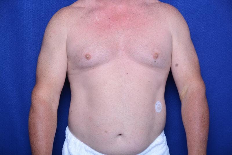 Gynecomastia Before & After Gallery - Patient 369541 - Image 5