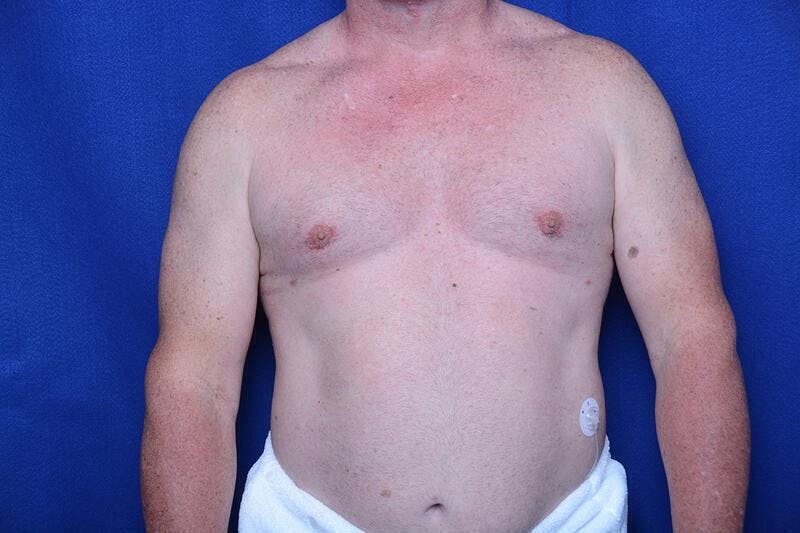 Gynecomastia Before & After Gallery - Patient 369541 - Image 6